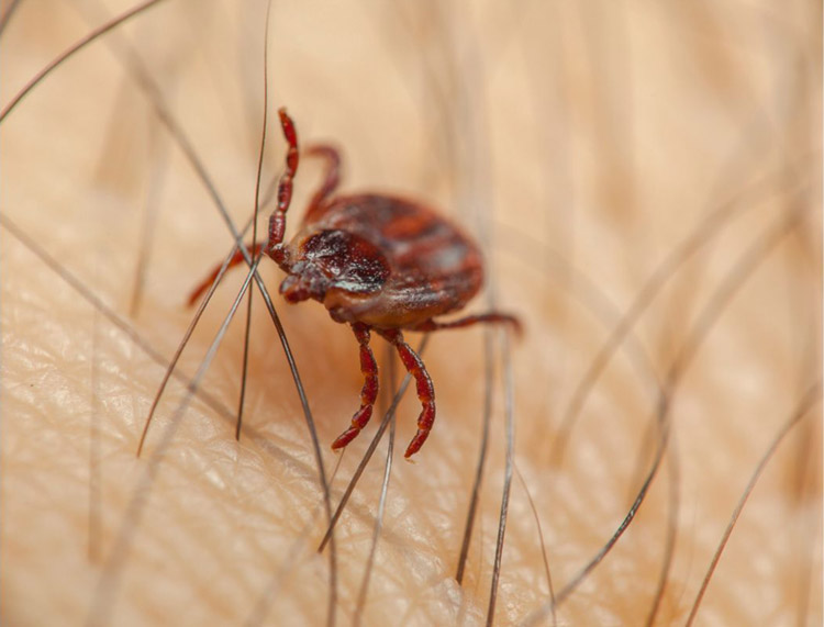 Tick parasite on a person 